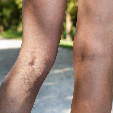 Are spider veins anything about? | Doctors Hospital