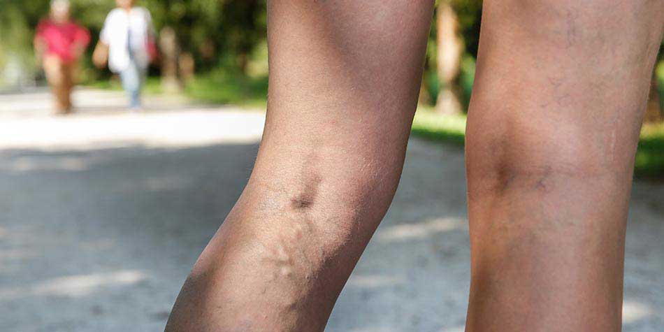 Are spider veins anything to worry about?